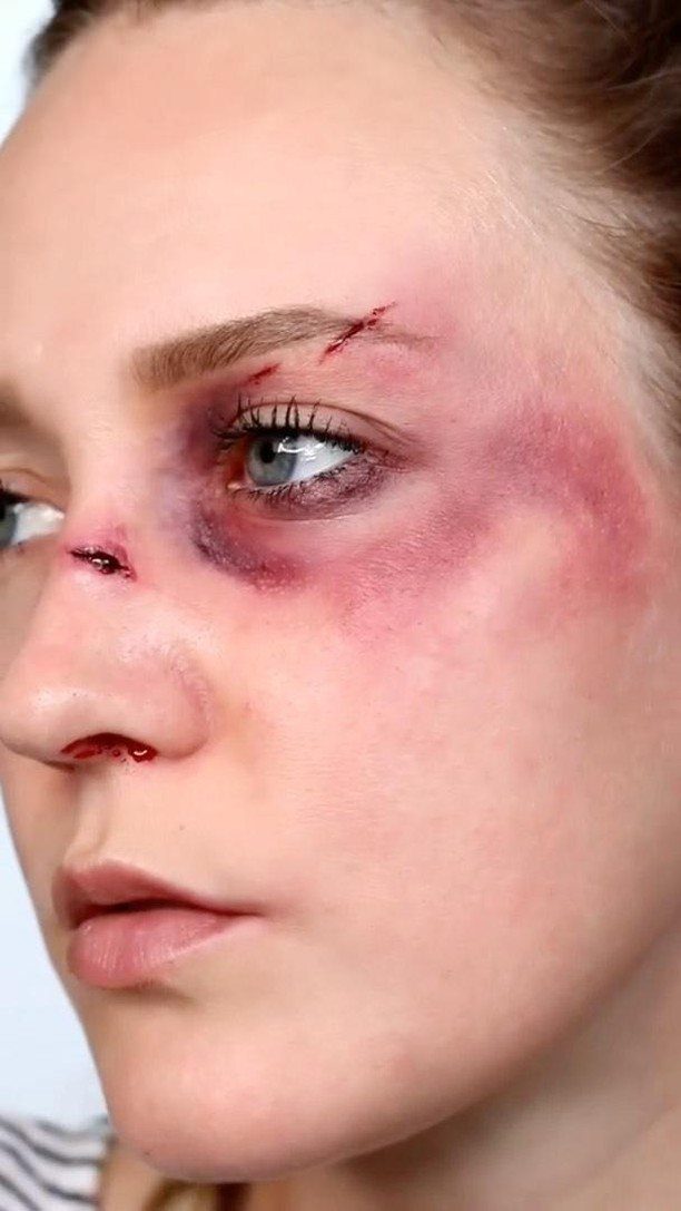 Woman with special effects makeup showing a black eye and facial cuts.